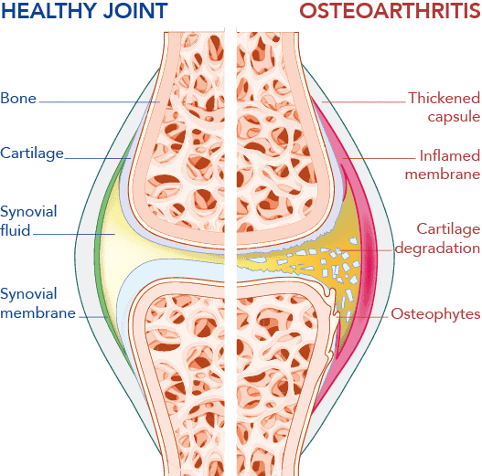 oa joint oa joint
